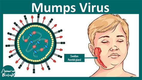 mumpd|mumps på svenska.